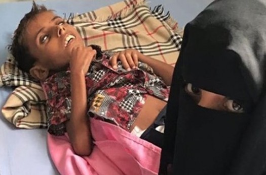 «آدم» 10 ساله؛ اولین قربانی محاصره الحدیده یمن از سوی ائتلاف سعودی